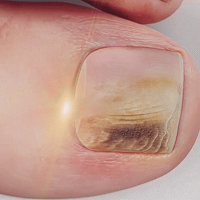 MicoCare - Adesivo para Unhas com Micose