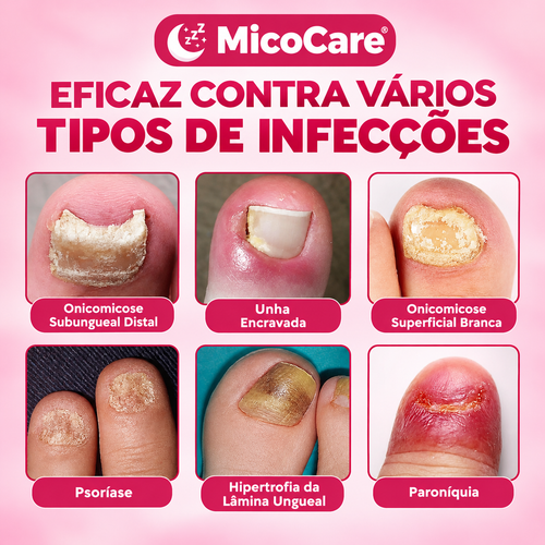 MicoCare - Adesivo para Unhas com Micose